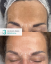 Dermo Peel Strength No.3 Renewal Before & After Result (4) Dermo Peel Strength No.3 Renewal Before & After Result (4)