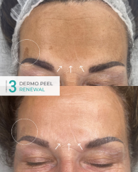 Dermo Peel Strength No.3 Renewal Before & After Result (4)