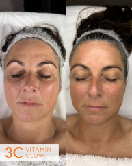 3C Vitamin Glow Before & After Result (2)
