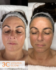 3C Vitamin Glow Before & After Result (2)
