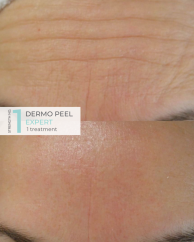 Dermo Peel Expert Strength 1 Before and After Results (1)