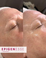 Epigenesse Energy Skin Restore Professional Treatment Results (2)